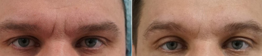 Пациент доктора Арслана Пенаева до и после процедуры Вечный Ботокс