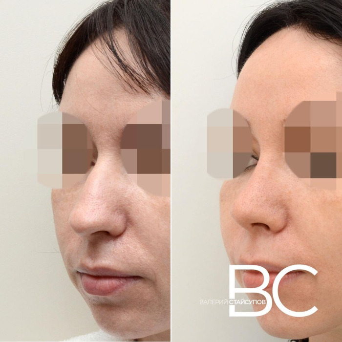 Пациентка Валерия Стайсупова до и после закрытой ринопластики