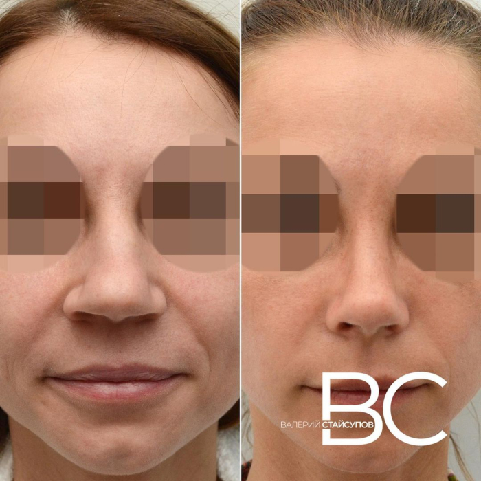Пациентка Валерия Стайсупова до и после закрытой ринопластики