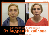 Андрей Михайлов. Фото до и после комплексного омоложения