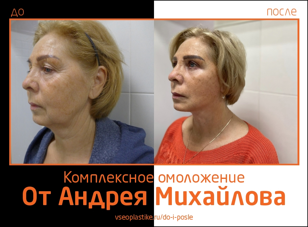 Андрей Михайлов. Фото до и после комплексного омоложения