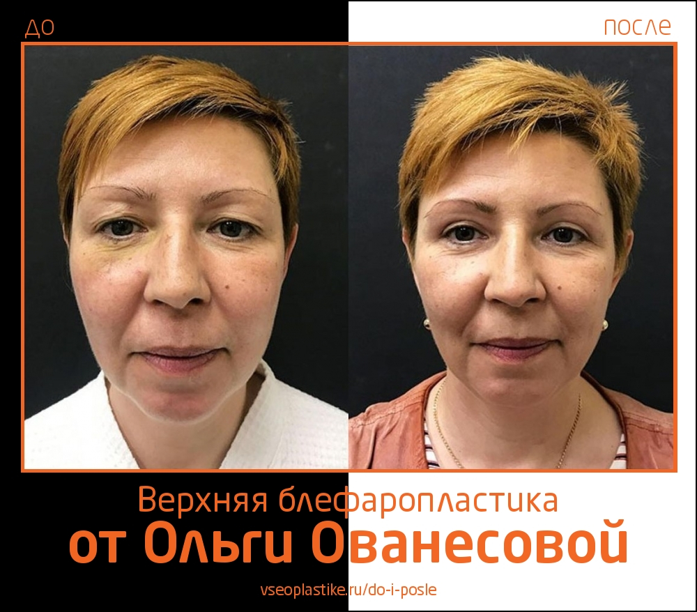  Ольга Ованесова. Фото до и после верхней блефаропластики