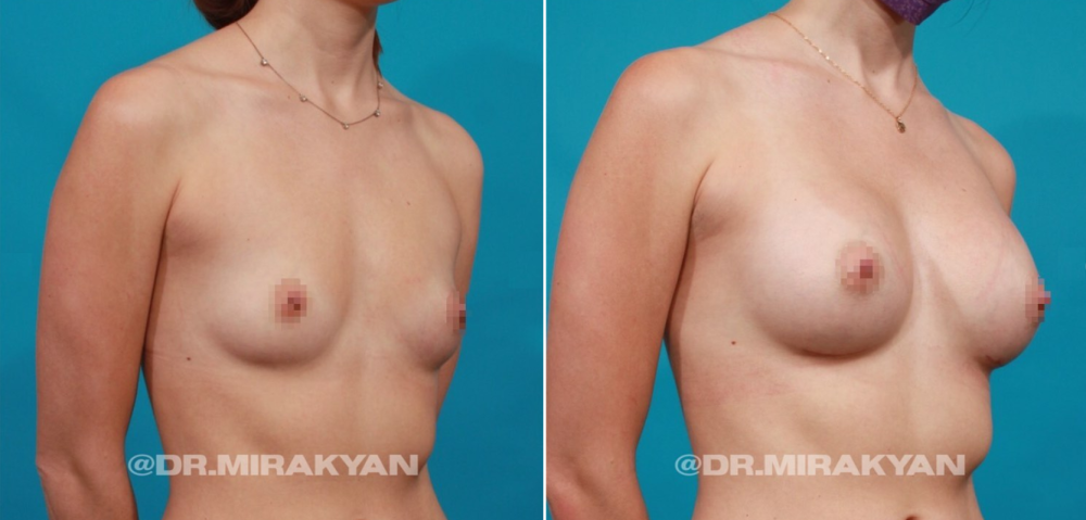 Пациентка до и после увеличения груди у доктора Гукаса Миракяна