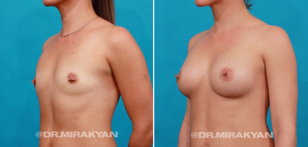 Пациентка до и после увеличения груди у доктора Гукаса Миракяна