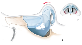 Седловидный нос