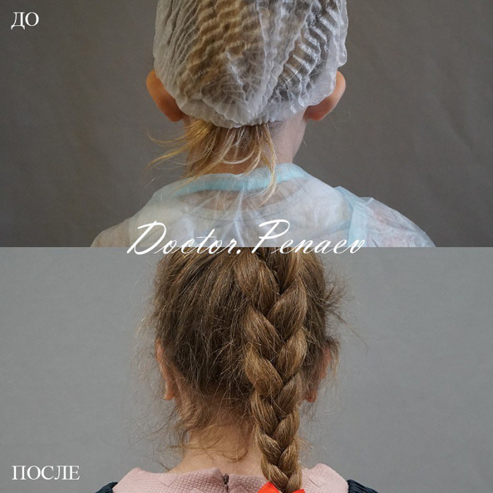 Пациентка доктора Арслана Пенаева до и после детской отопластики