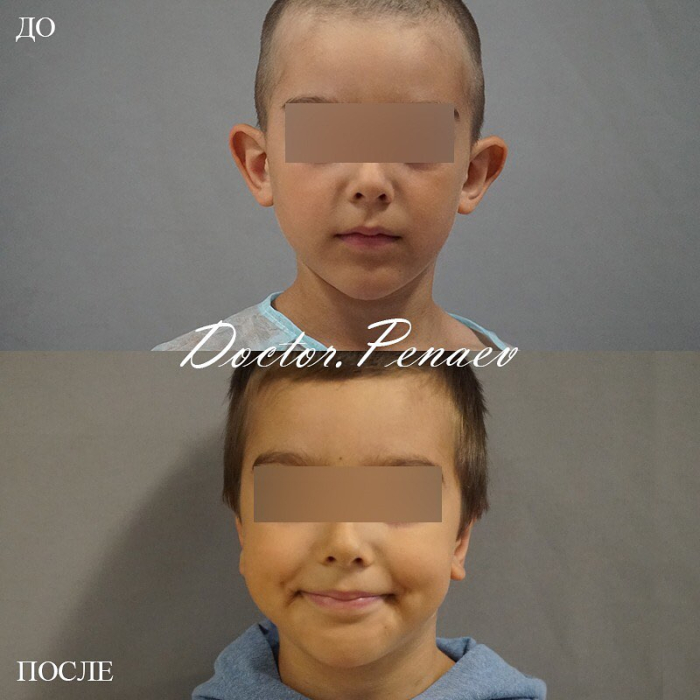 Пациент доктора Арслана Пенаева до и после детской отопластики