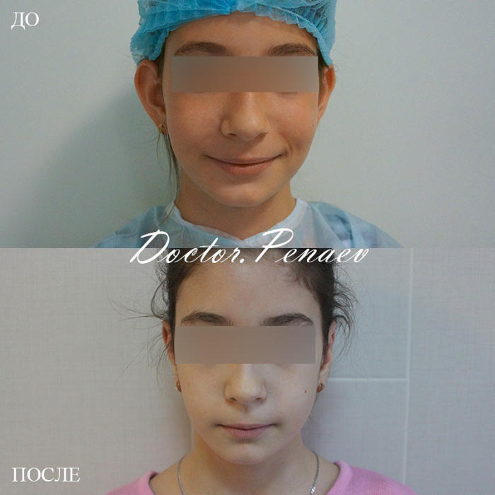 Пациентка доктора Арслана Пенаева до и после детской отопластики