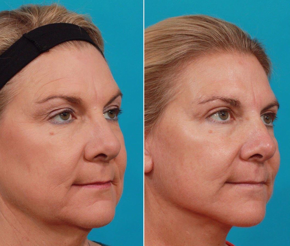 подтяжка лица Гукас Миракян