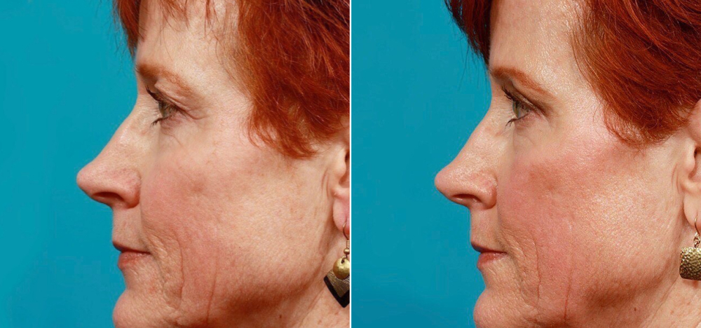 круговая блефаропластика Гукас Миракян