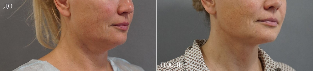 Пациентка доктора Пенаева до и после омоложения лица и шеи