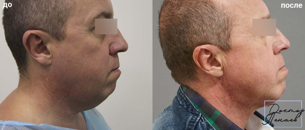 Пациент доктора Пенаева до и после аквалифтинга