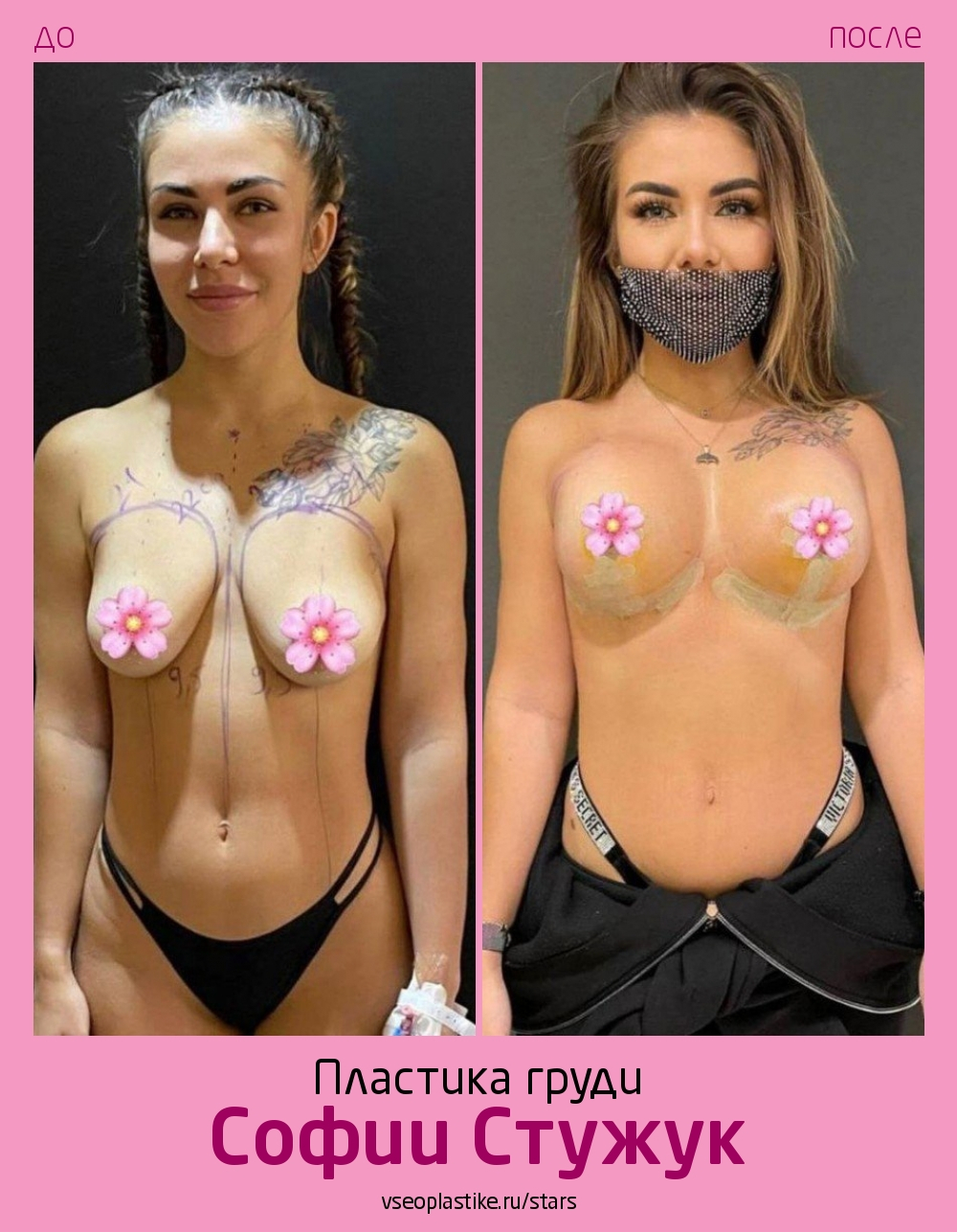 София Стужук до и после пластики