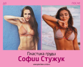 София Стужук до и после пластики