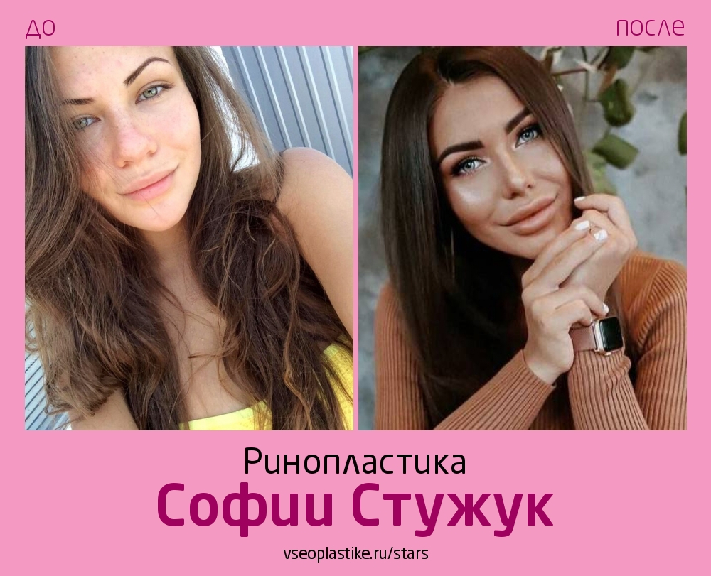 Соня Стужук ринопластика
