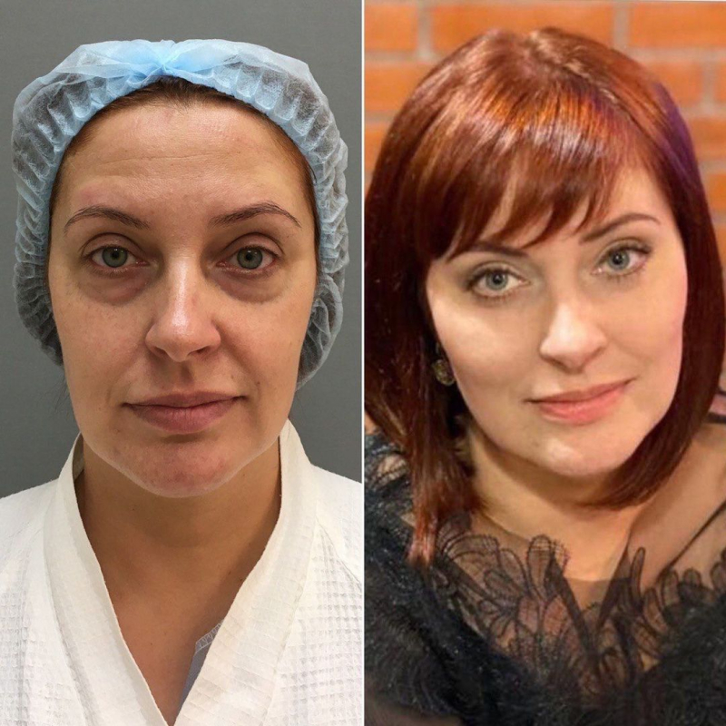Пациентка пластического хирурга Марины Четвериковой до и после эндоскопической подтяжки средней трети лица