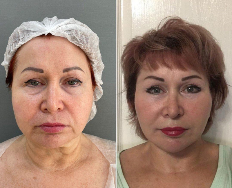 Пациентка доктора Четвериковой до и после омоложения лица.