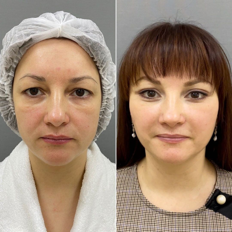 Пациентка пластического хирурга Марины Четвериковой до и после эндоскопической подтяжки средней трети лица