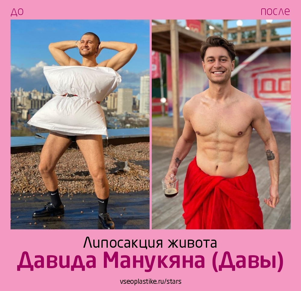 Давид Манукян до и после липосакции и подтяжки живота