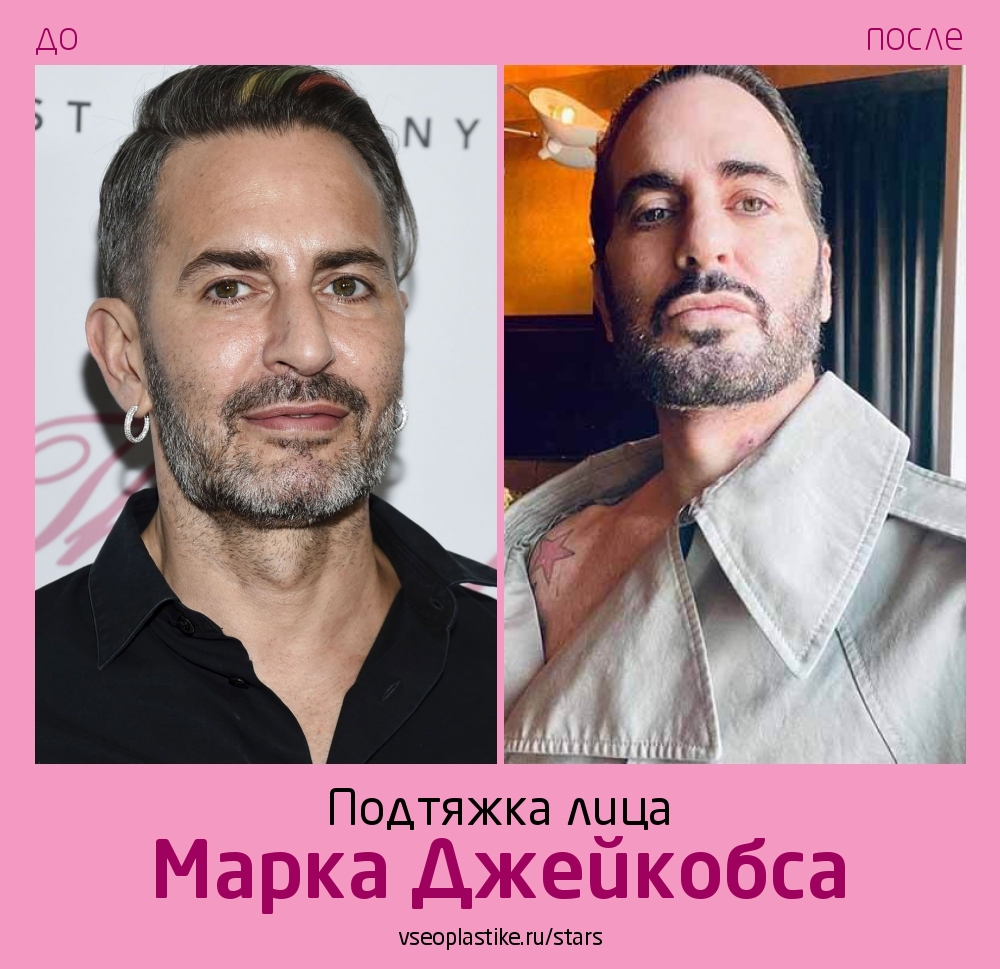Марк Джейкобс до и после подтяжки лица