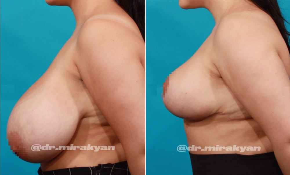 Пациентка доктора Гукаса Миракяна до и после уменьшения груди