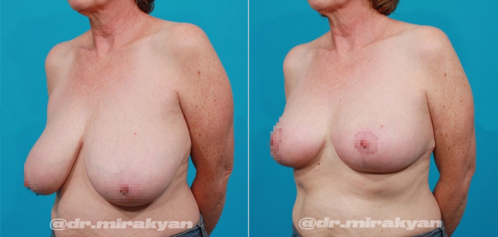 Пациентка доктора Гукаса Миракяна до и после уменьшения груди