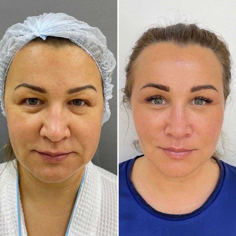 Пациентка хирурга Четвериковой до и после эндоскопического омоложения лица