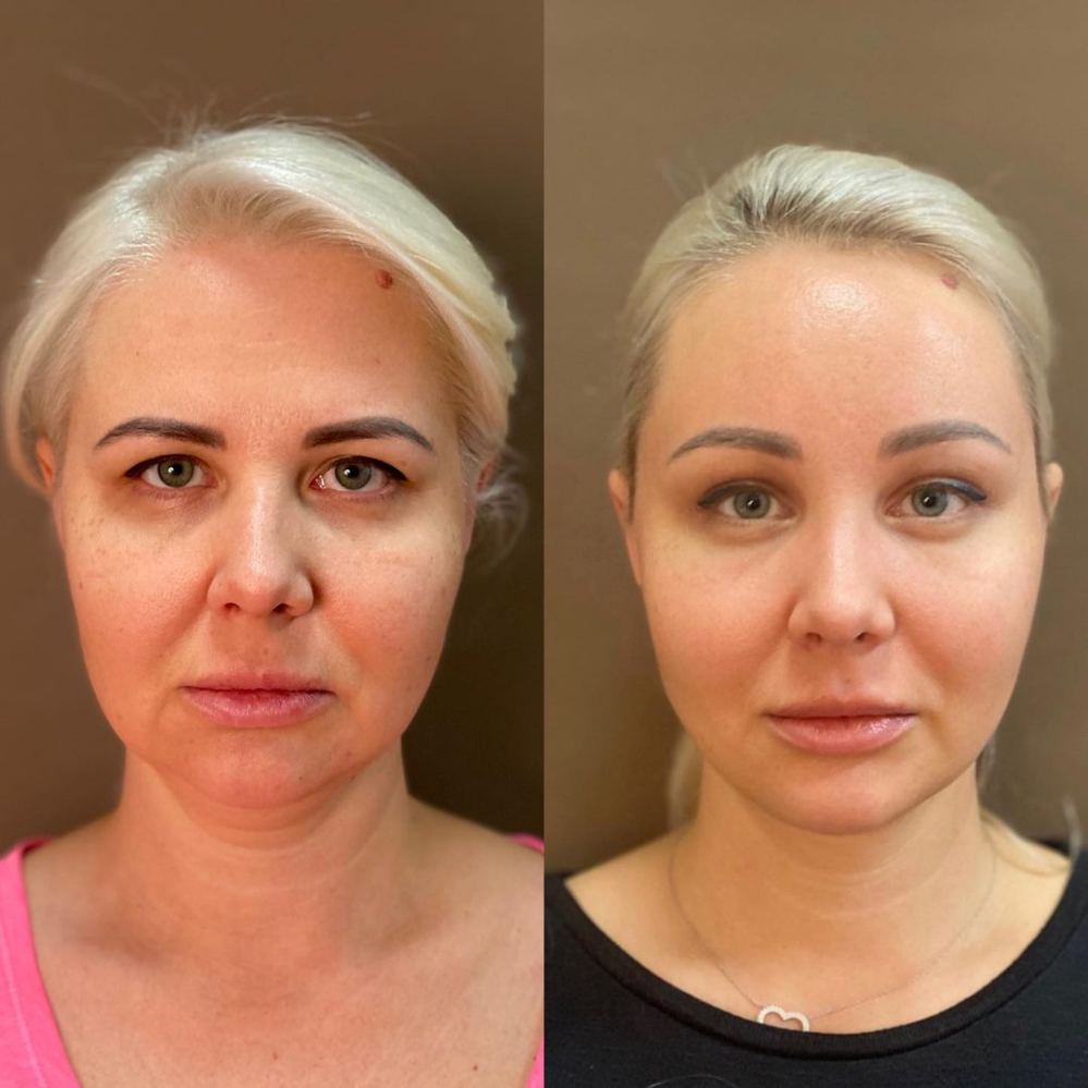 Пациентка доктора Светланы Пшонкиной до и после омоложения лица