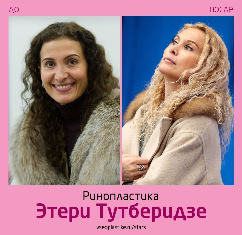 Этери Тутберидзе до и после ринопластики