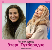 Этери Тутберидзе до и после ринопластики