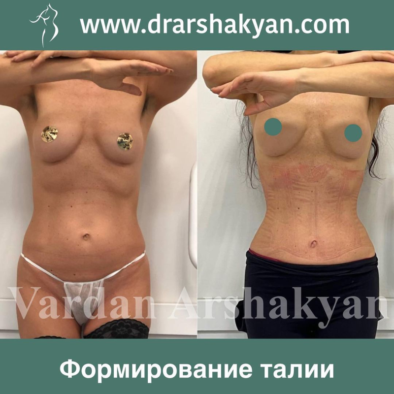 Пациентка хирурга Вардана Аршакяна до и после операции по созданию узкой талии