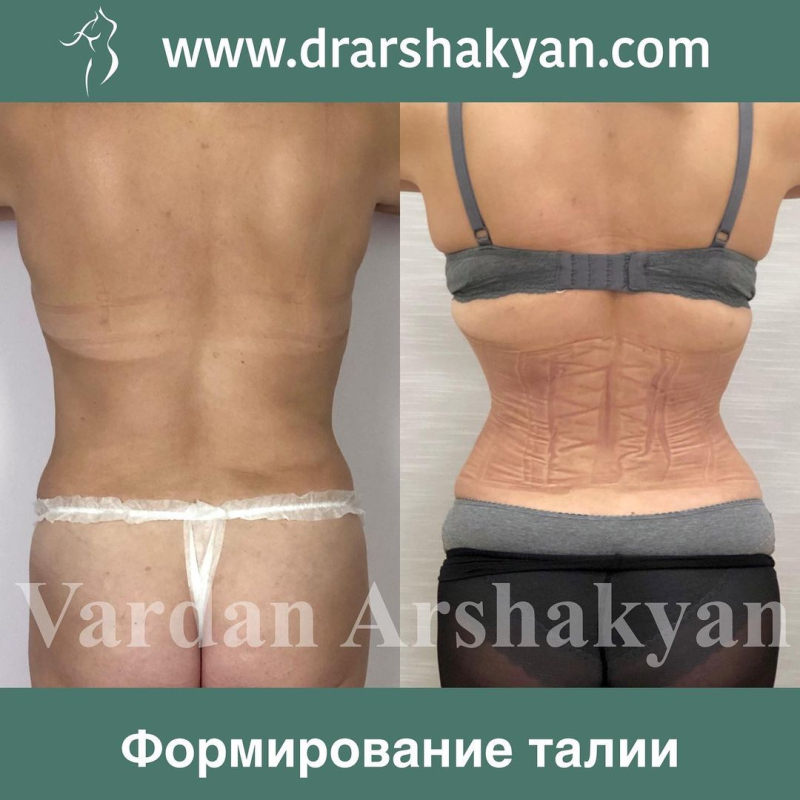 Пациентка хирурга Вардана Аршакяна до и после операции по созданию узкой талии