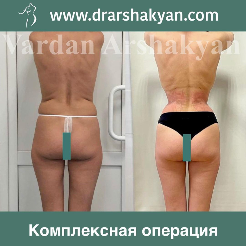 Пациентка хирурга Вардана Аршакяна до и после операции по созданию узкой талии