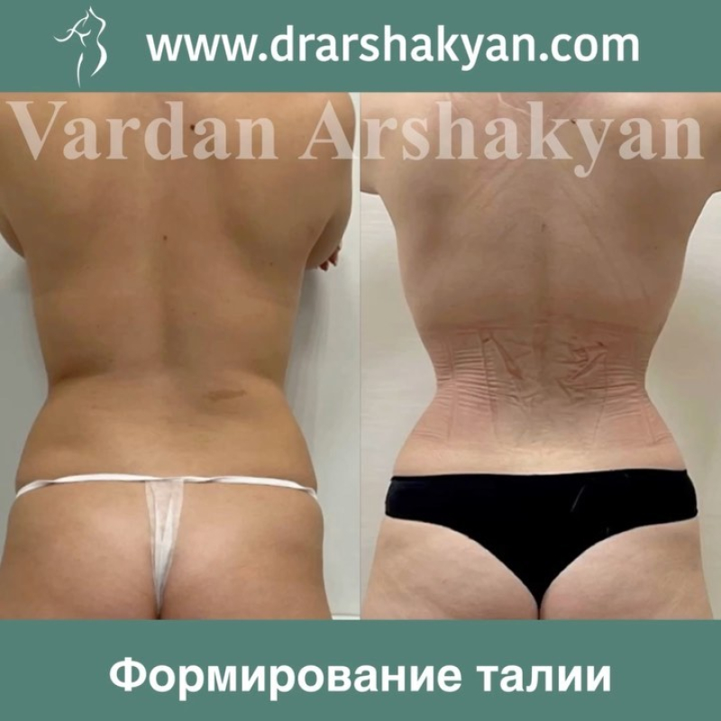 Пациентка хирурга Вардана Аршакяна до и после операции по созданию узкой талии