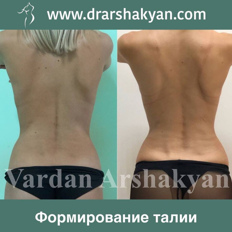 Пациентка хирурга Вардана Аршакяна до и после операции по созданию узкой талии