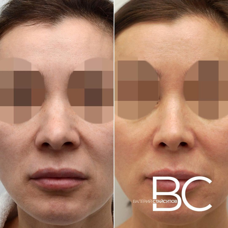 Пациентка пластического хирурга Валерия Стайсупова до и после закрытой ринопластики