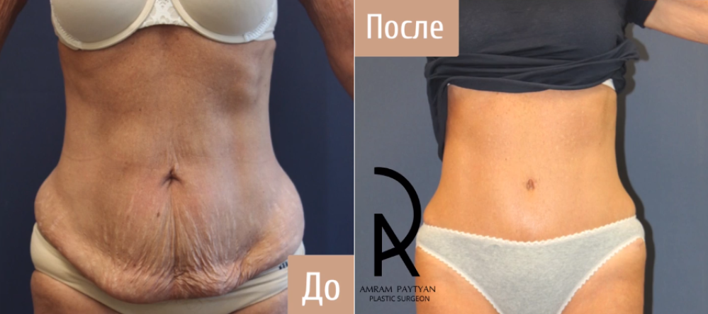Пациентка пластического хирурга Амрама Пайтяна до и после абдоминопластики