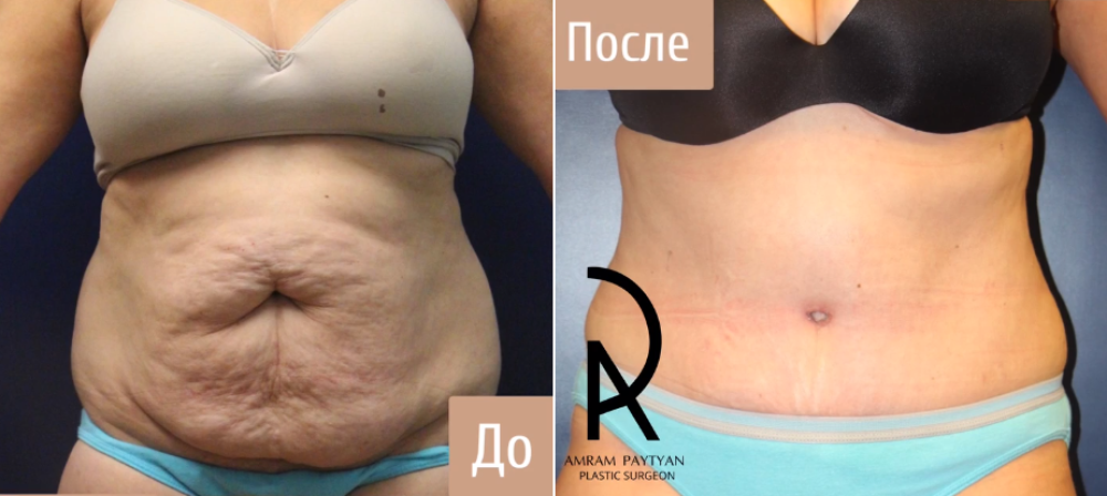 Пациентка пластического хирурга Амрама Пайтяна до и после абдоминопластики