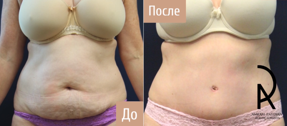Пациентка пластического хирурга Амрама Пайтяна до и после абдоминопластики