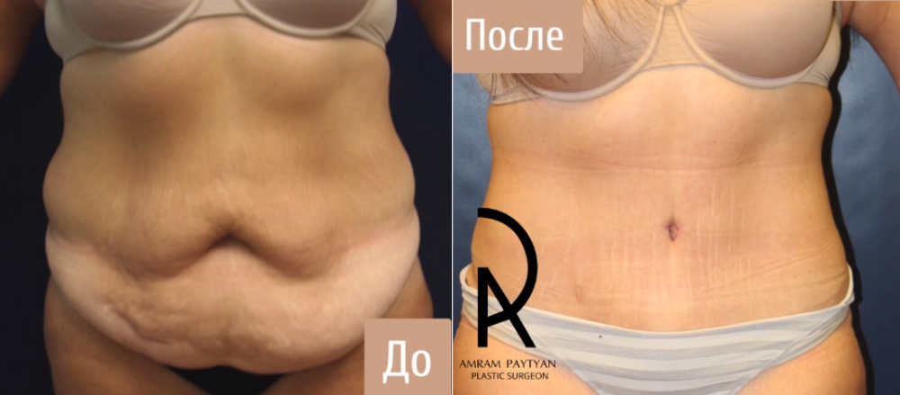 Пациентка пластического хирурга Амрама Пайтяна до и после абдоминопластики
