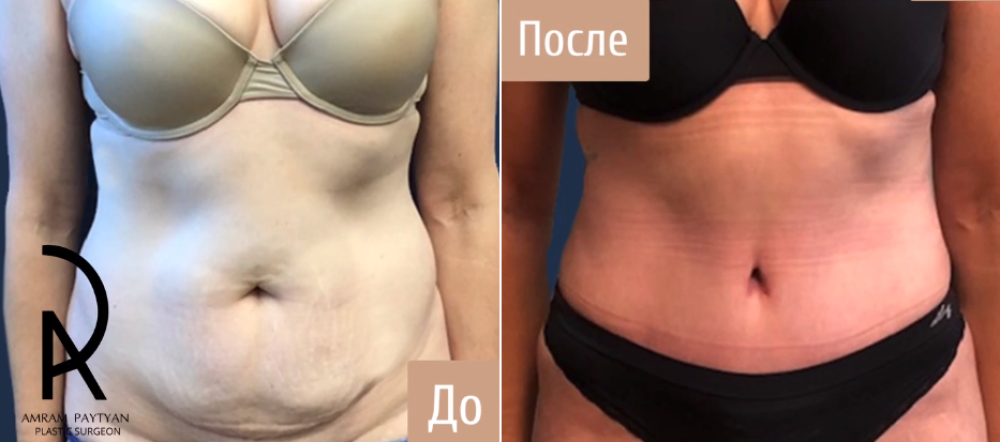Пациентка пластического хирурга Амрама Пайтяна до и после абдоминопластики