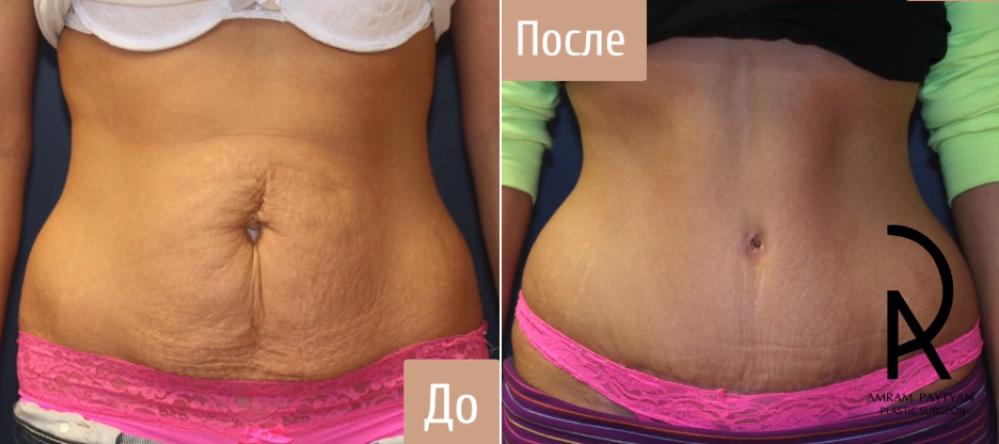Пациентка пластического хирурга Амрама Пайтяна до и после абдоминопластики