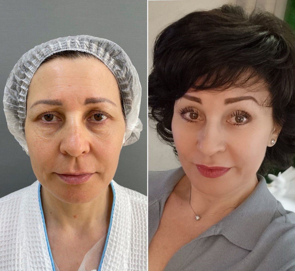 Пациентка доктора Марины Четвериковой до и после омоложения лица