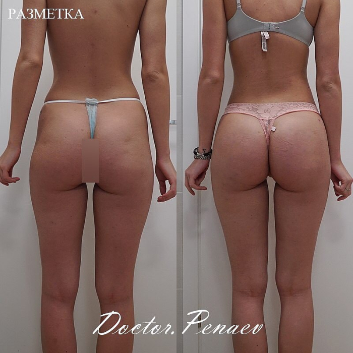 Пациентка пластического хирурга Арслана Пенаева до и после липотрансфера ягодиц