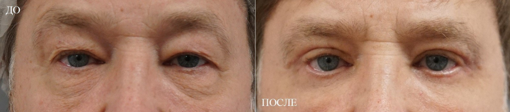 Пациент пластического хирурга Арслана Пенаева до и после блефаропластики верхних и нижних век.
