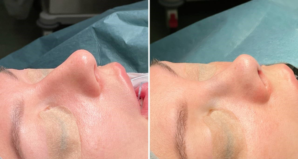 Пациентка пластического хирурга Валерия Стайсупова до и после закрытой ринопластики