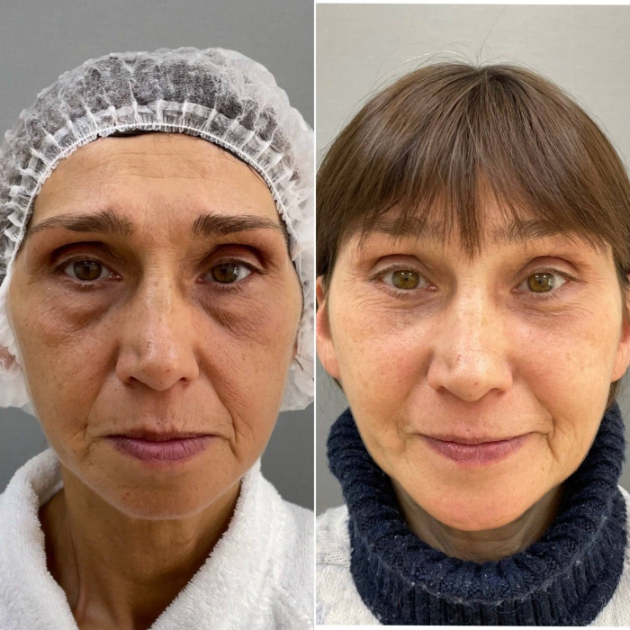 Пациентка пластического хирурга Марины Четвериковой до и после омоложения лица
