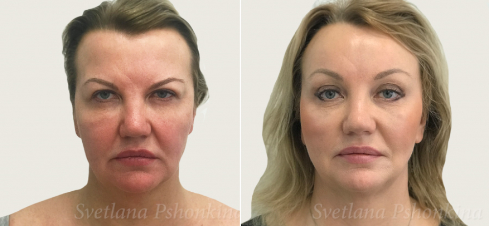 Светлана Пшонкина Силуэт Лифт