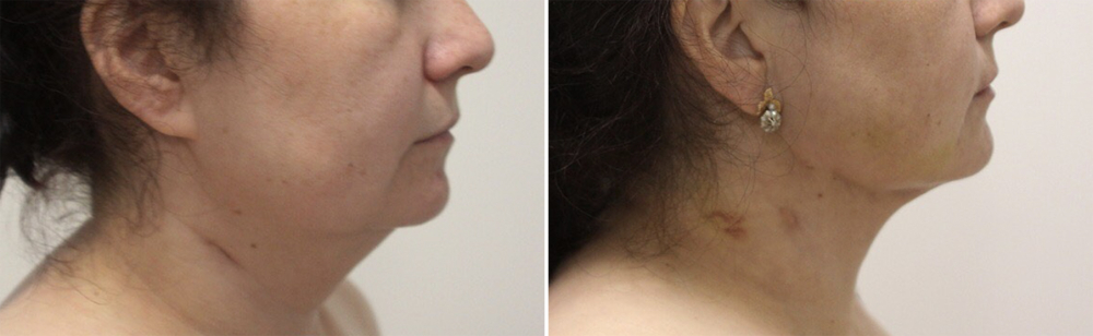 Пенаев подтяжка нитями