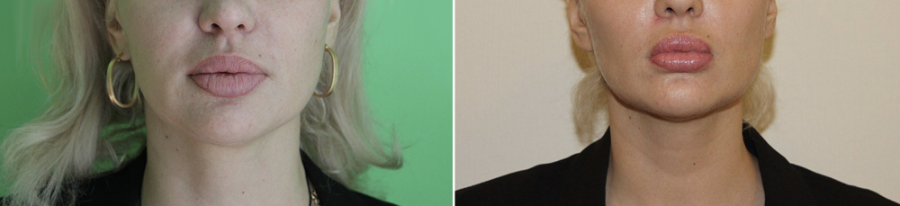 Пенаев подтяжка нитями